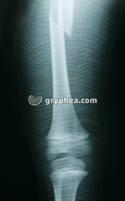 Radiographie de Fémur fracturé - gryphea.com